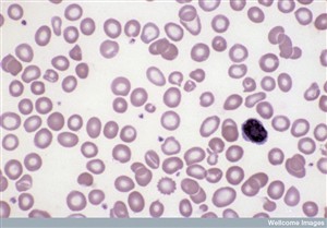 Photo:Blood cells showing iron deficiency anaemia