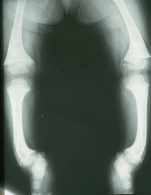 Photo:X-ray of rickets